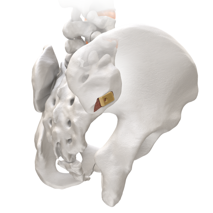 Sacroiliac Joint Pain 